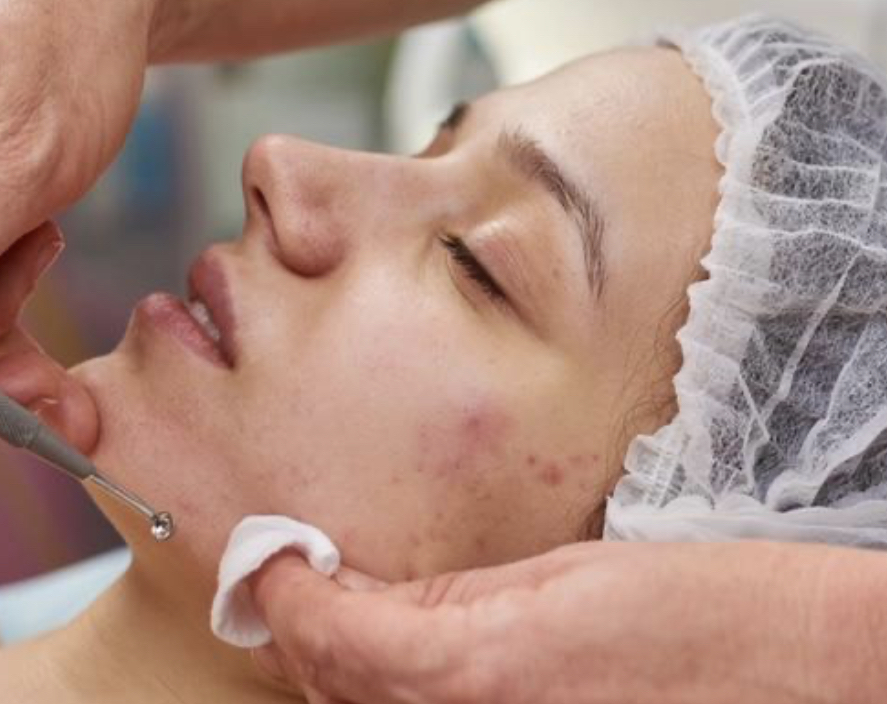 Acne Treatment