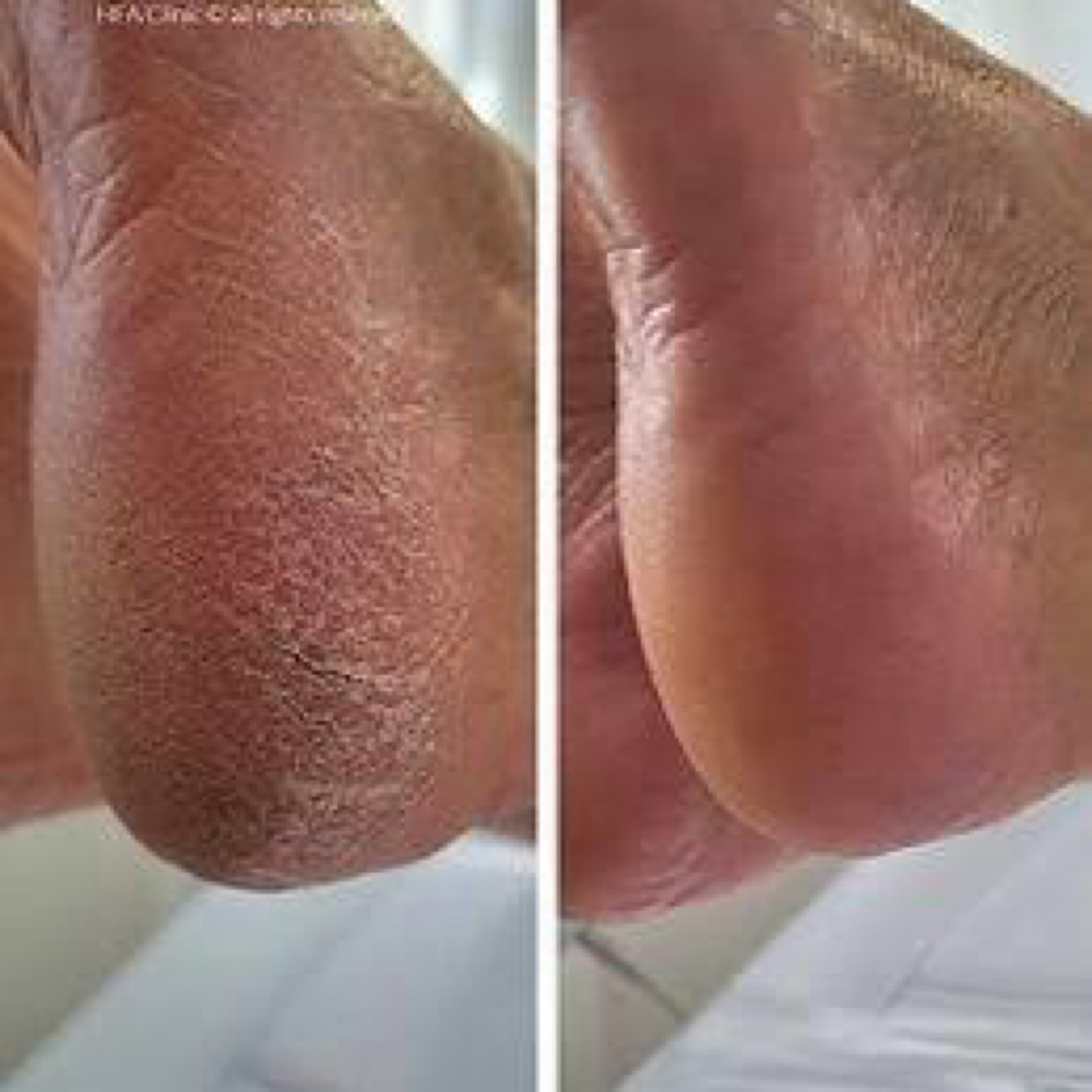 Callus Reduction at Sole Revive “Pedi Lab” in Odessa, TX