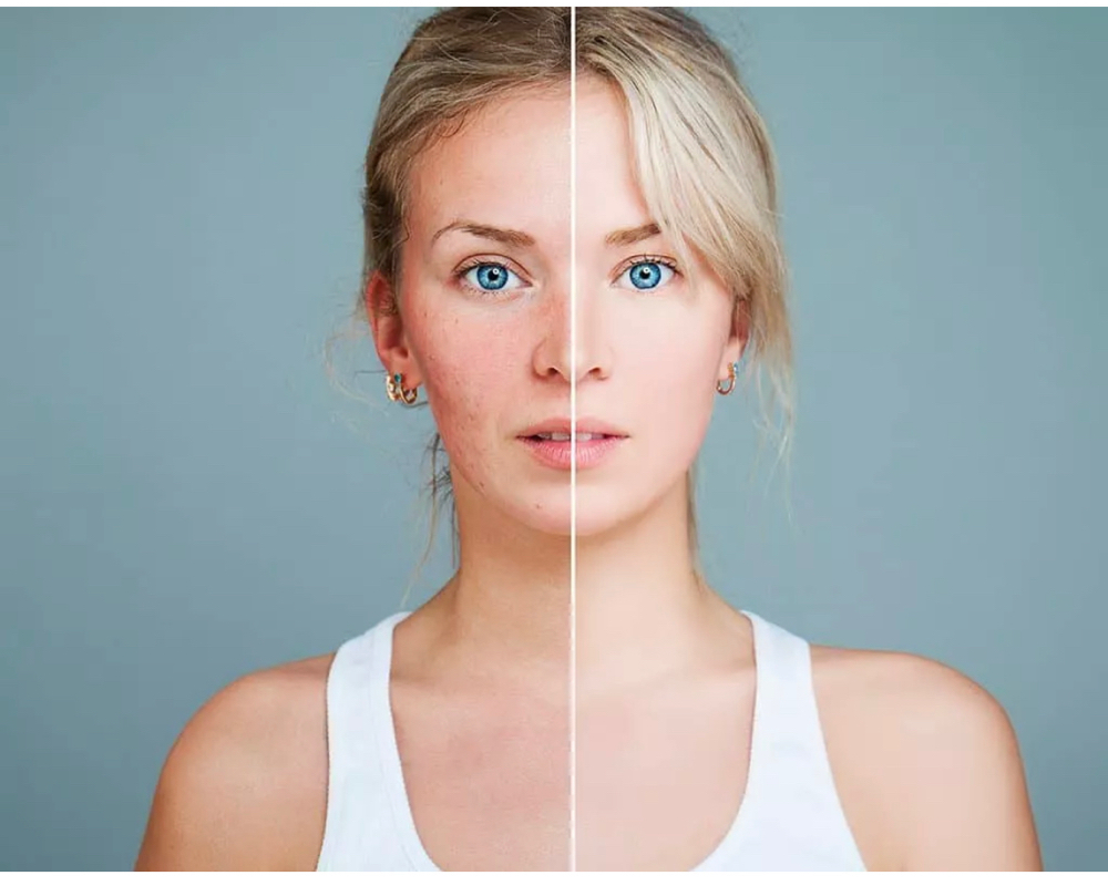 Microdermabrasion
