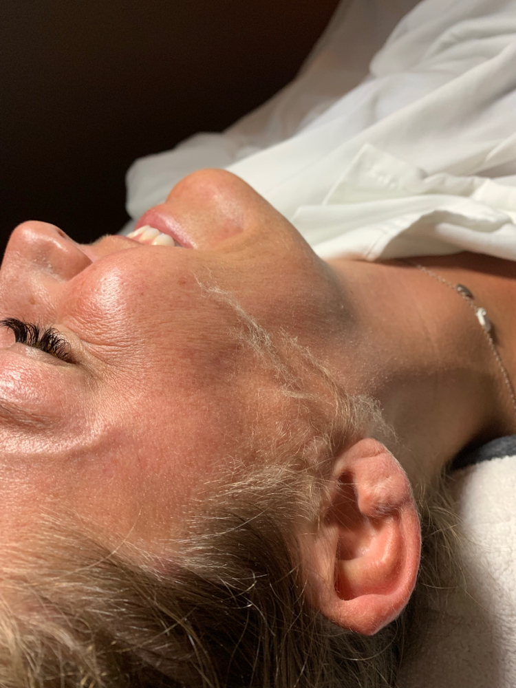 Dermaplaning