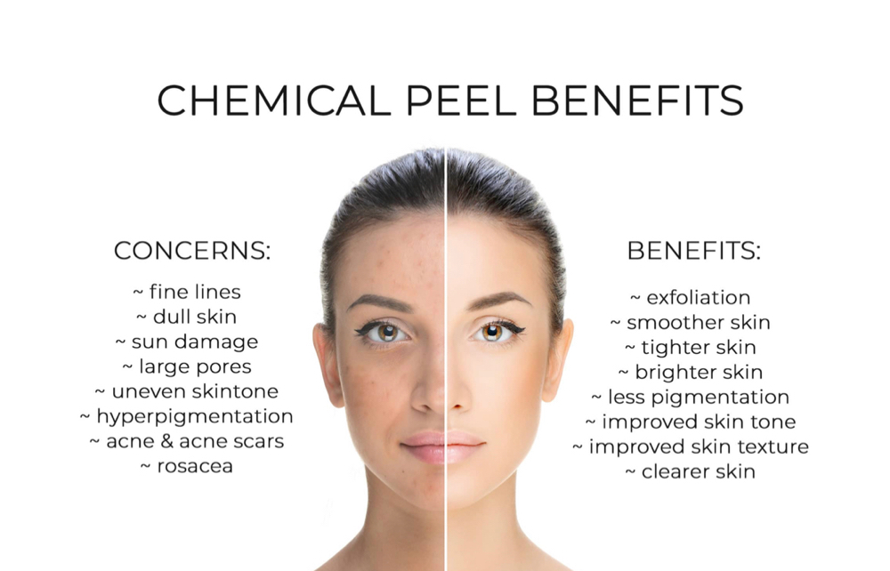 CHEMICAL PEEL