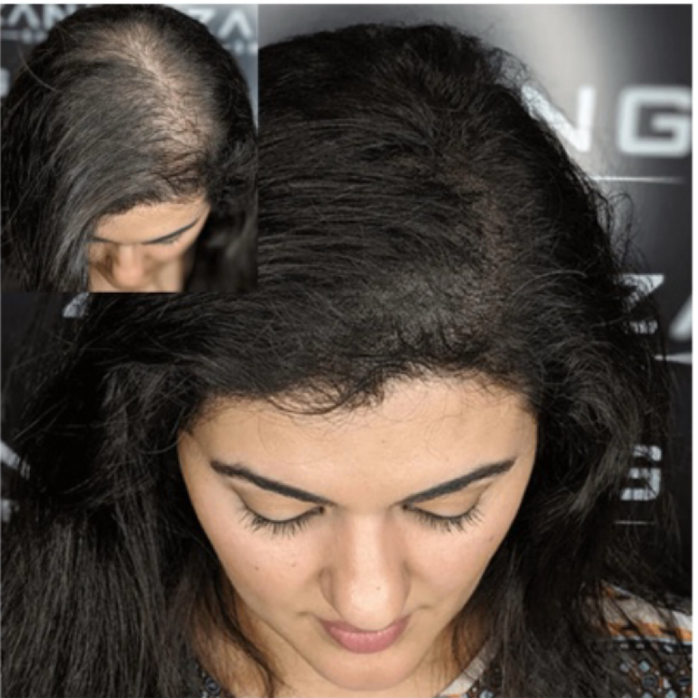 Scalp Micropigmentation Package at Luna Wellness Beauty & Reiki Studios in Phoenix, AZ