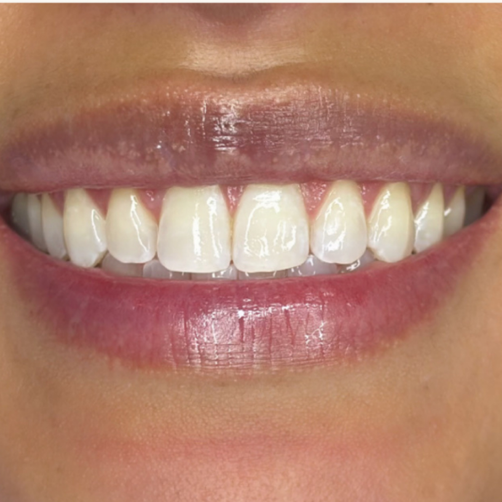 Radiance Boost — Shade Enhancement at Luna Smiles in Lexington, SC
