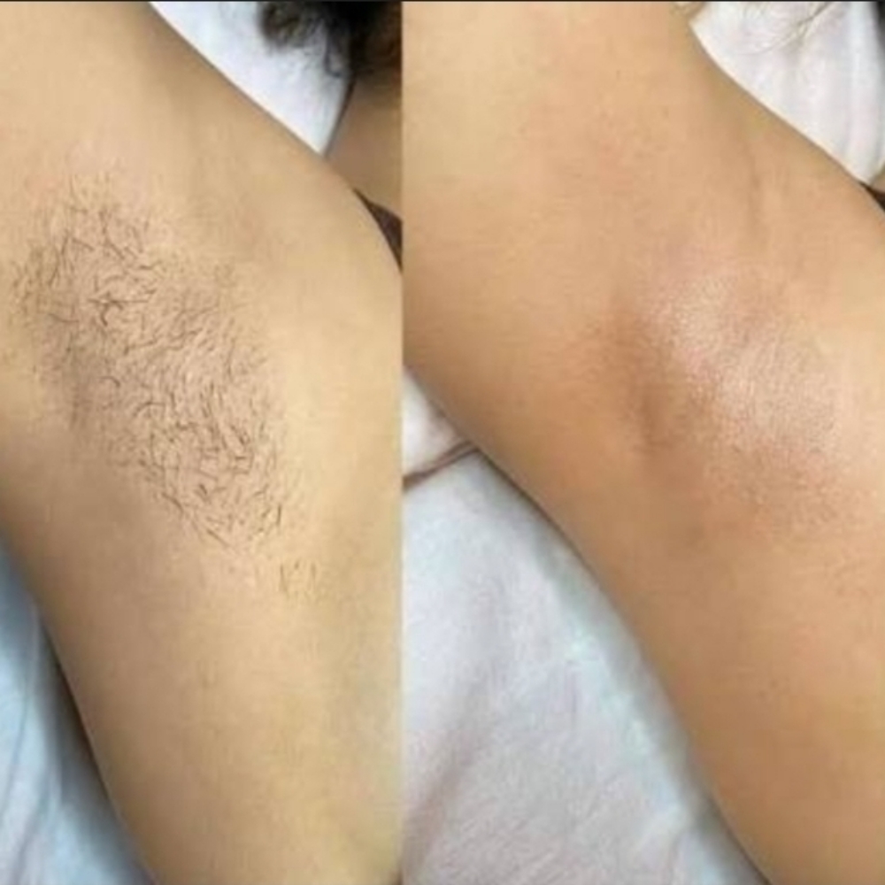 Underarm Laser at BELLALOTOMH beauty lash studio in Beltsville, MD