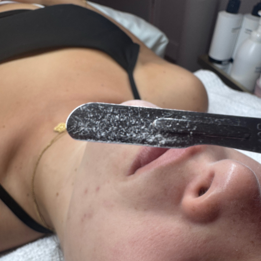 Dermaplaning at Skyn Esthetics INC. in Boca Raton, FL