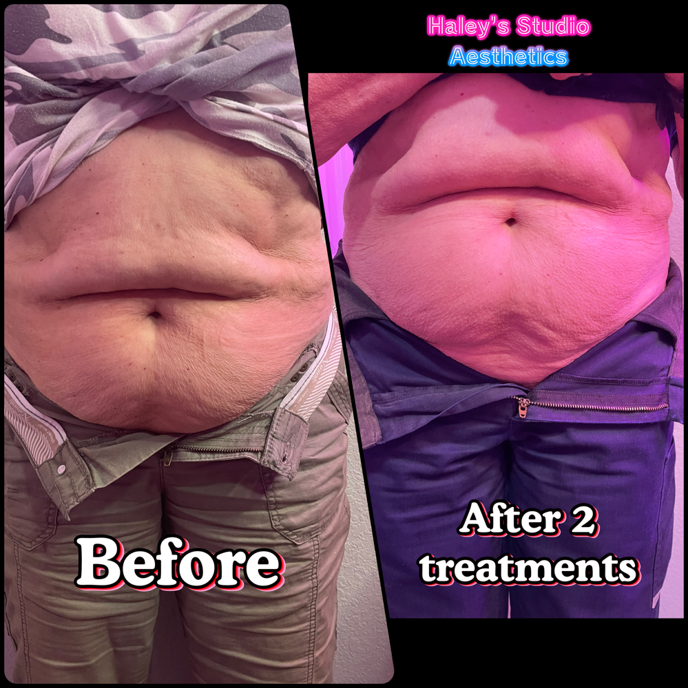 Liquid Lipo-fat Dissolver