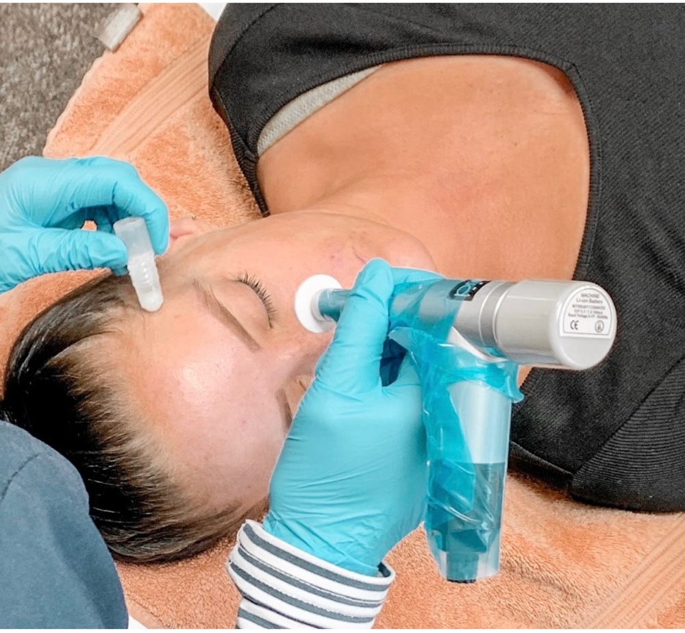 Micro Channeling / Stem Cells at Trubeauty Esthetics in Idaho Falls, ID