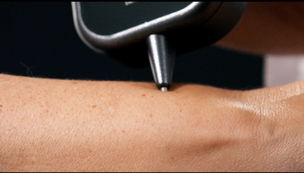 Single Mole Scan at Effortless Esthetics LLC in Scottsdale, AZ