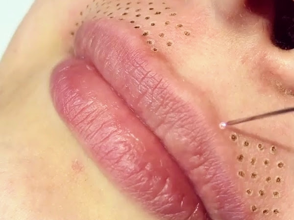Fibroblast Full Lip Flip