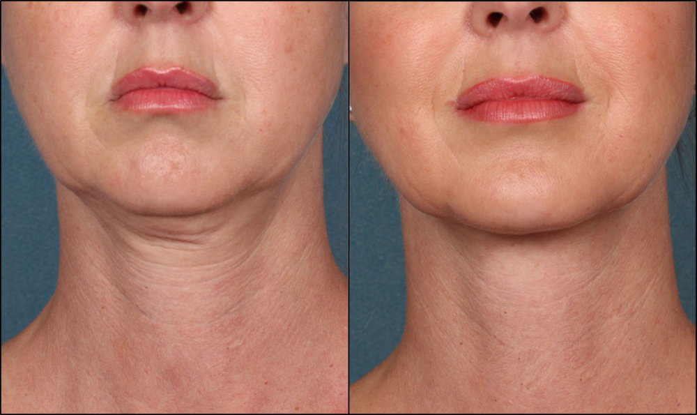 Radiofrequency Facial