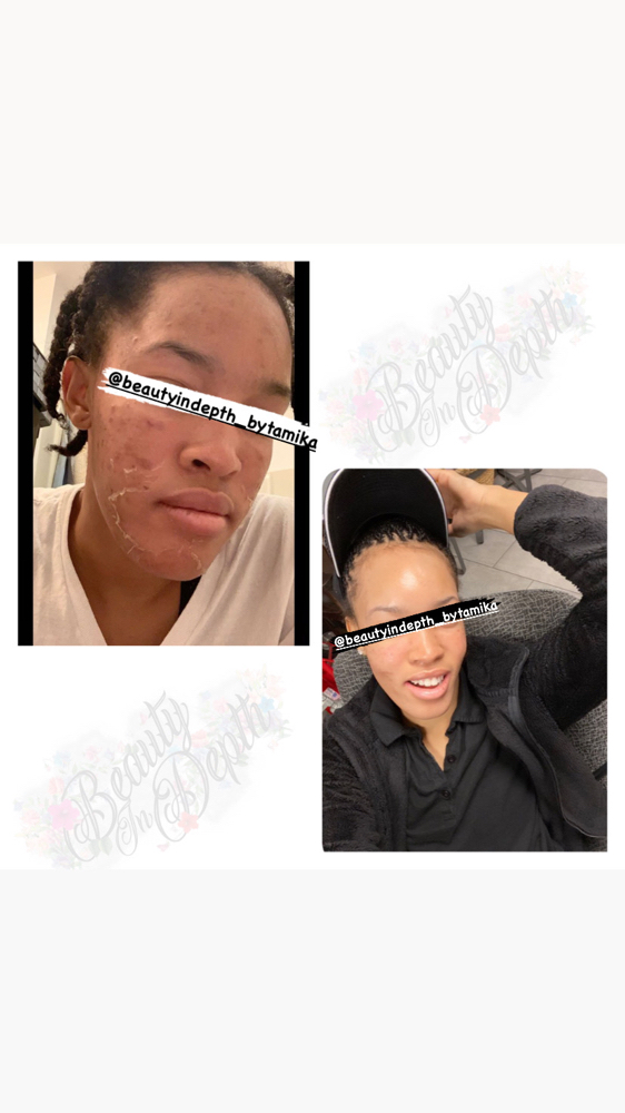 BID’s Skin Renewal X3 Peel Series