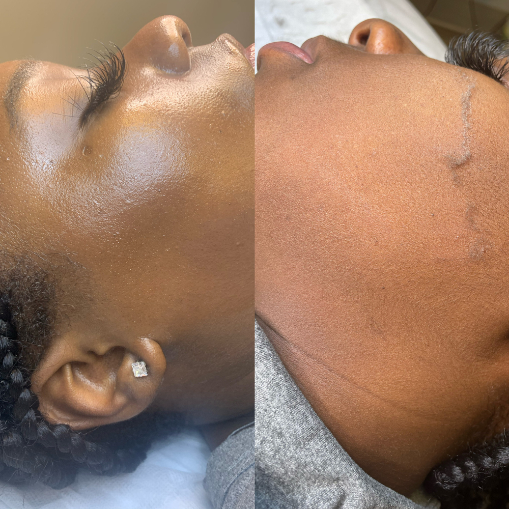 Dermalplaning W/ Deluxe Facial