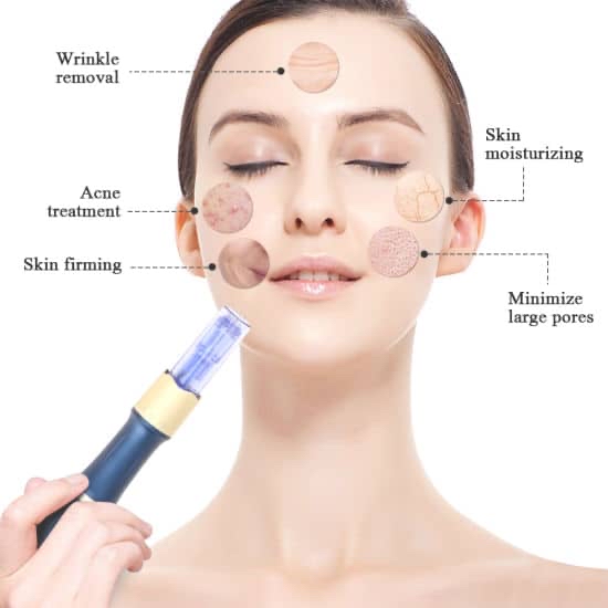 Microneedling