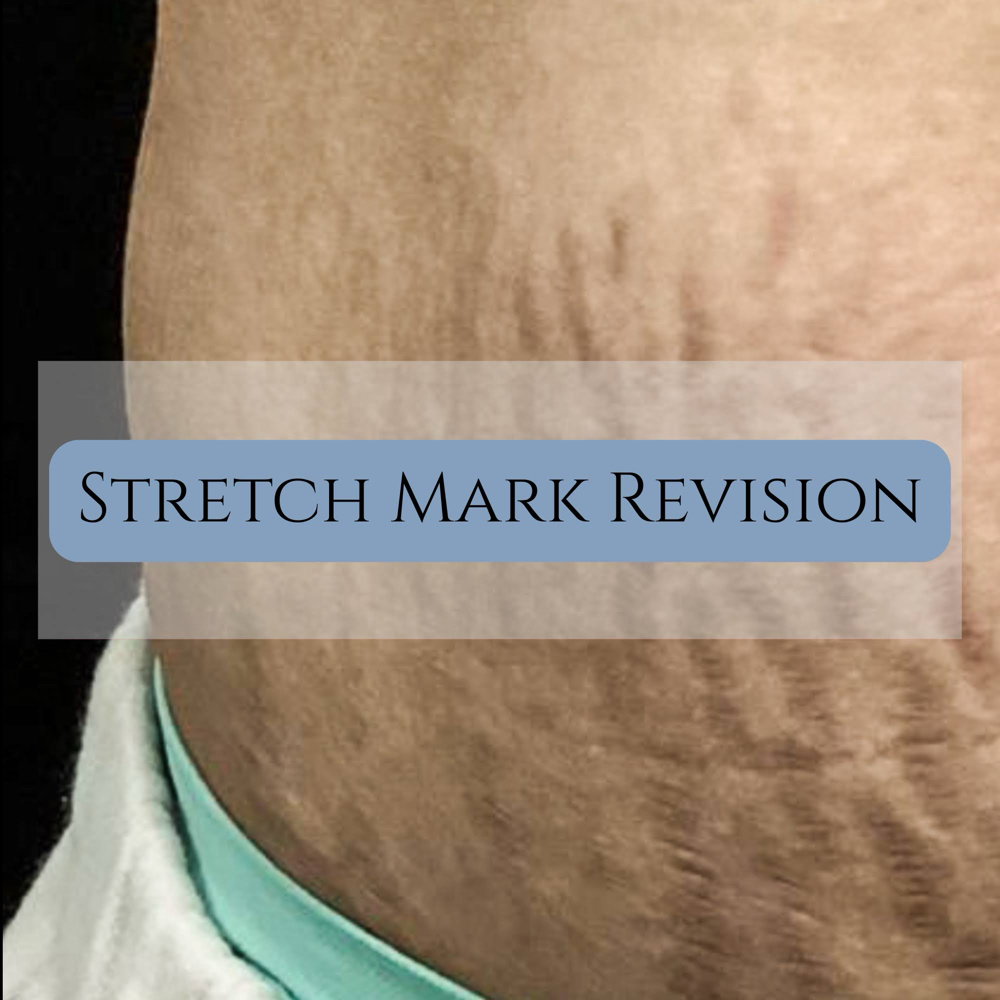 Stretch Mark Revision at Carolina Restorative Aesthetics in Greer, SC