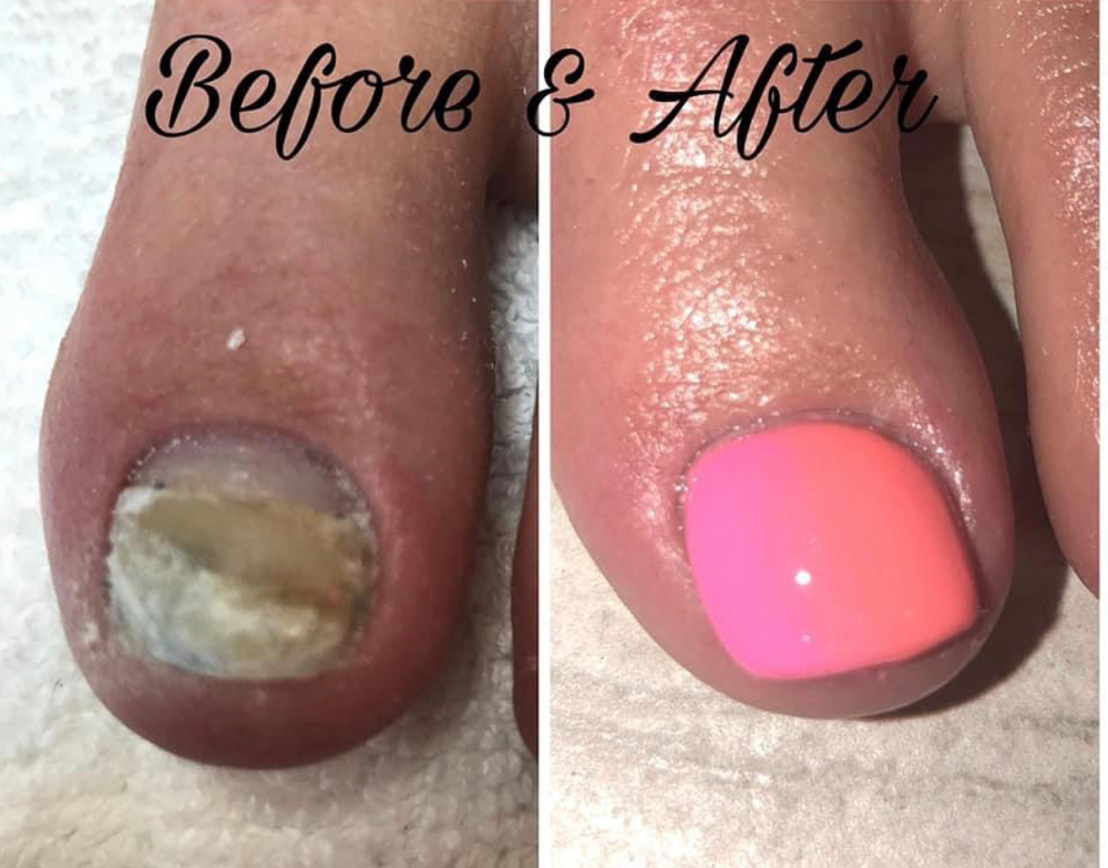 Toenail Reconstruction-Follow Up