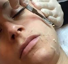 DERMAPLANING