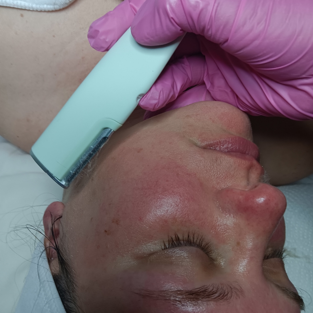 Dermaflash Dermaplaning Treatment