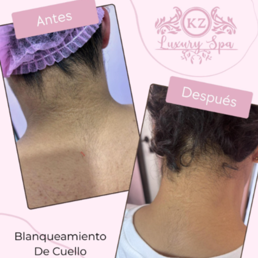 Blanqueamiento Intimo+laser at Kz Luxury Spa in Houston, TX