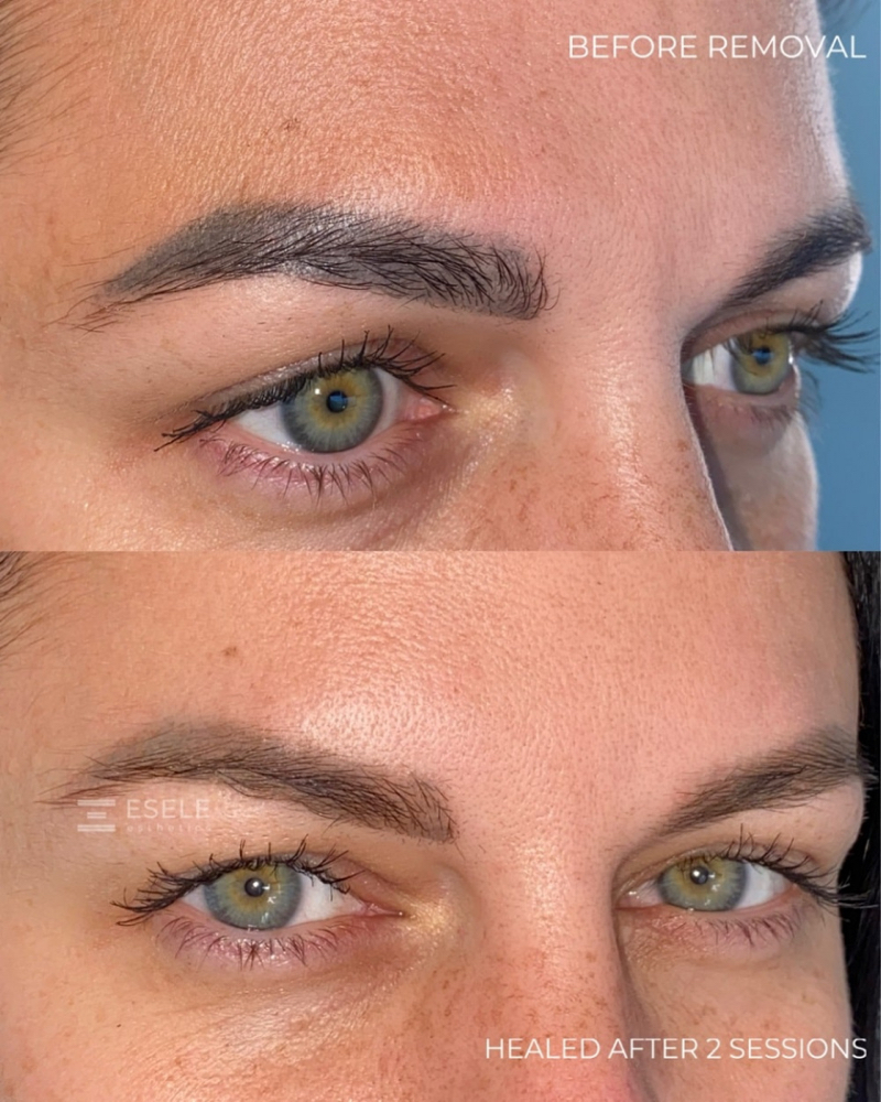 Non-laser PMU removal at Alina PMUartist in Lincolnshire, IL