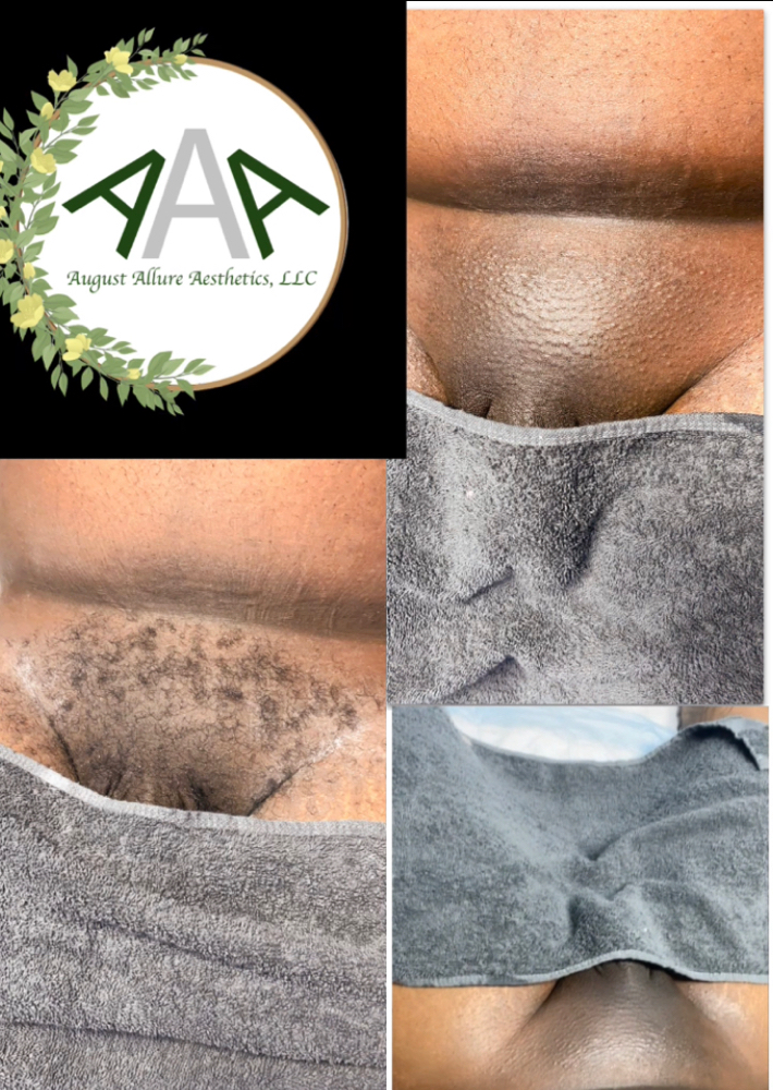 Mankini Full Front at August Allure Aesthetics LLC in Lehigh Acres, FL