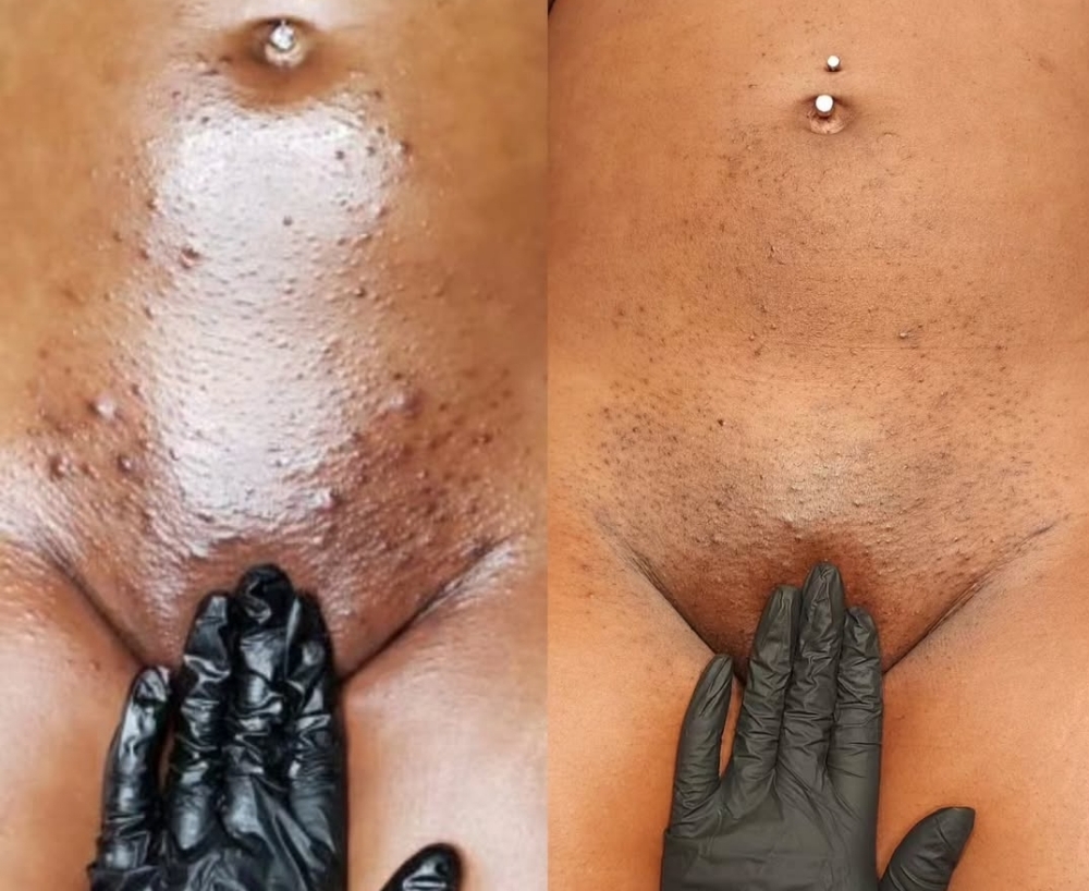 Brazilian + Intimate Peel Series