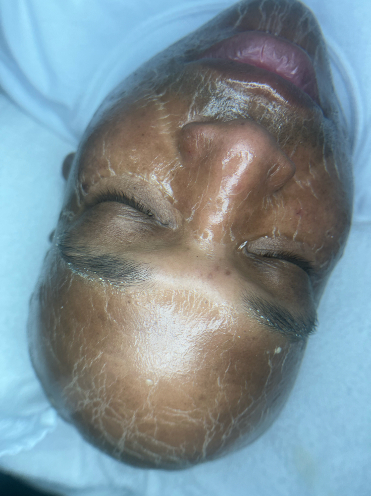 Circadia Botox Facial