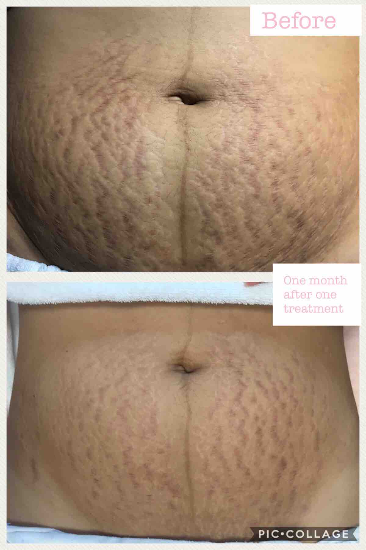 Strech Mark Removal Microneedling