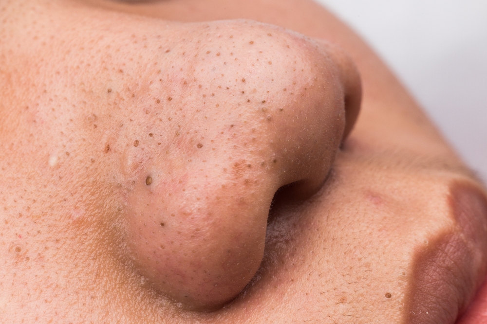 Acne Relief Treatment at Esthetician4u By Tessa in Bakersfield, CA