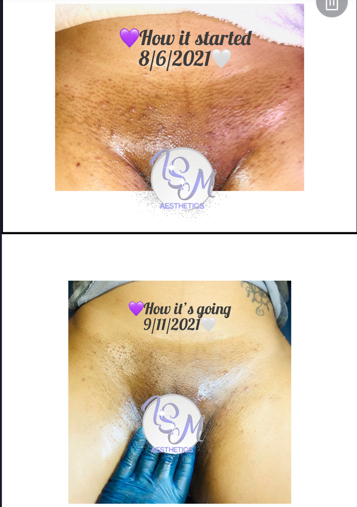 Brazilian Wax/Vajacial