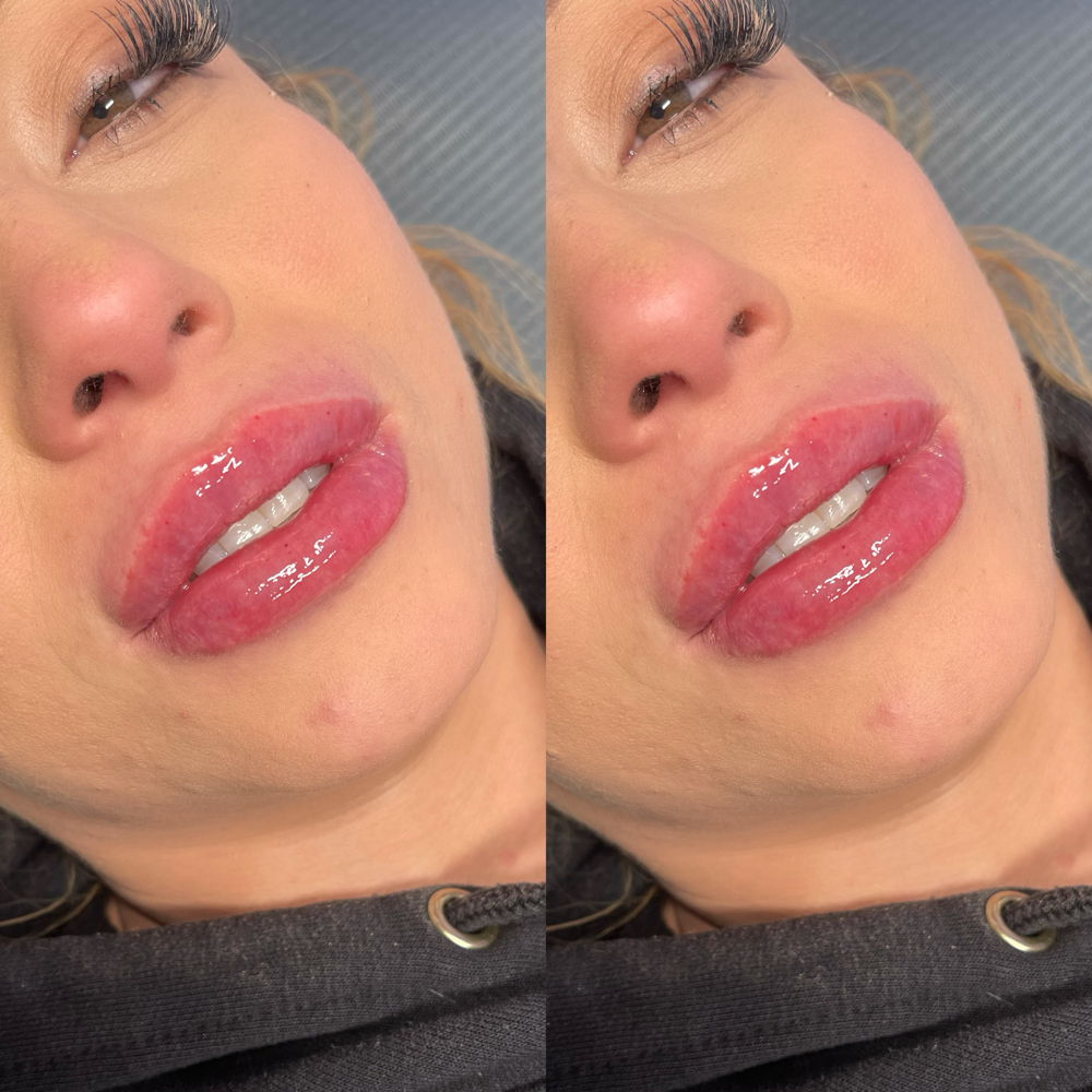 TOUCH UP (LIP FILLERS)