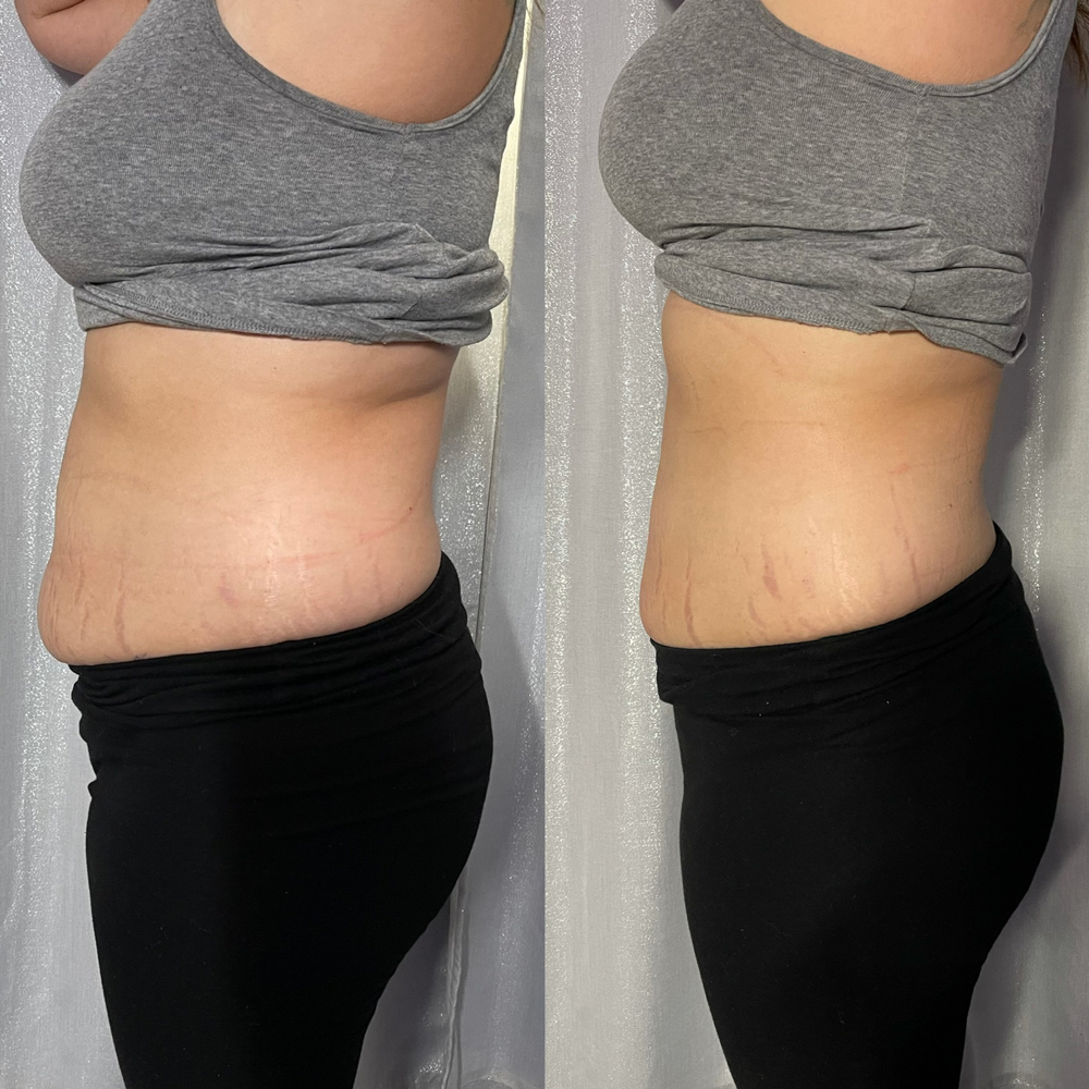 Laser Lipo