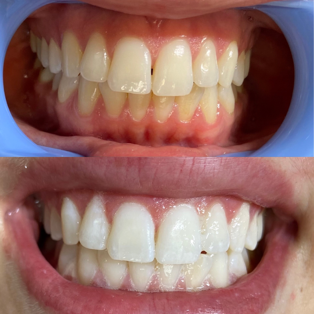 Teeth Whitening 60 Min