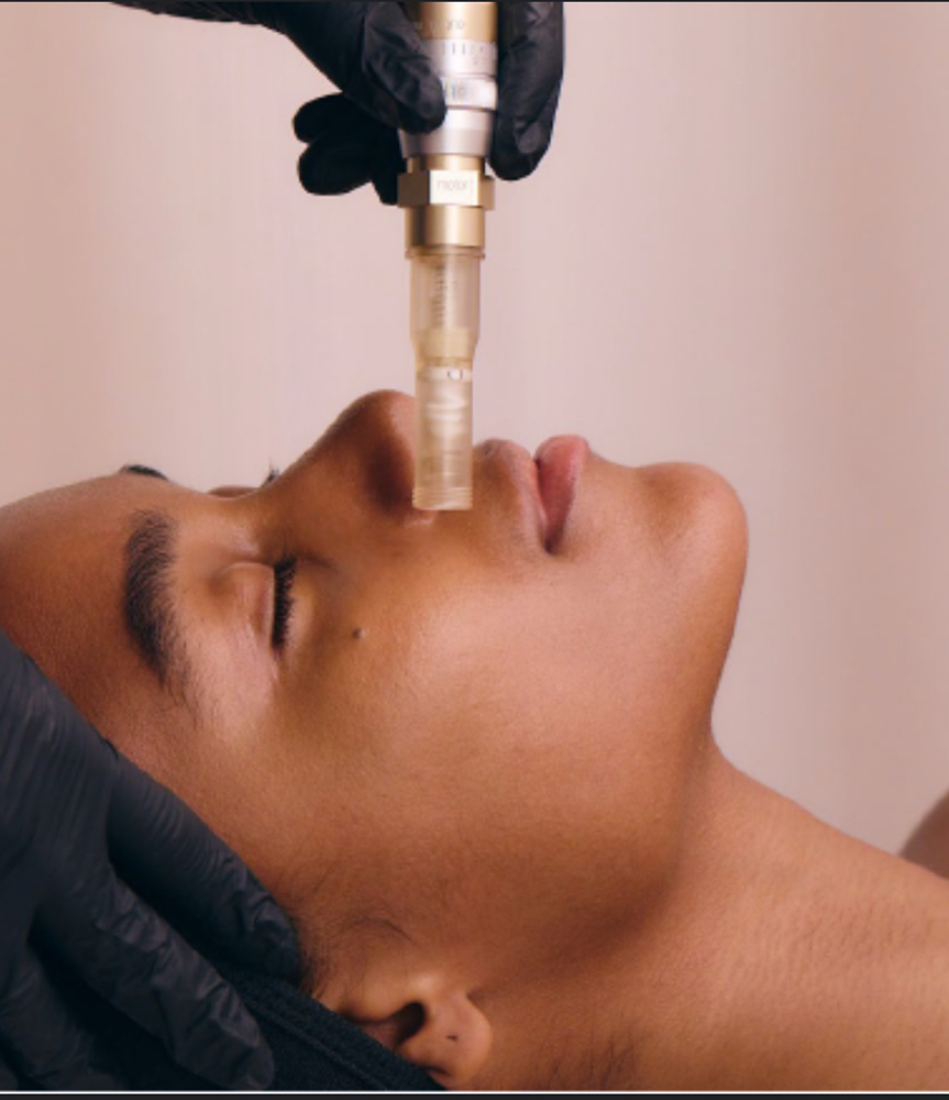 Nano- Needling at Indulgence Beauty LLC in Tacoma, WA