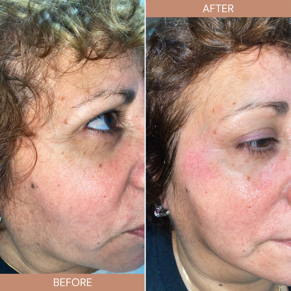 Radio Frequency Face Correction