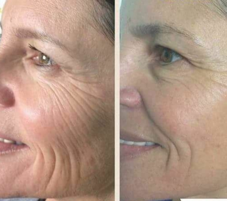 Anti-aging Advanced Peel