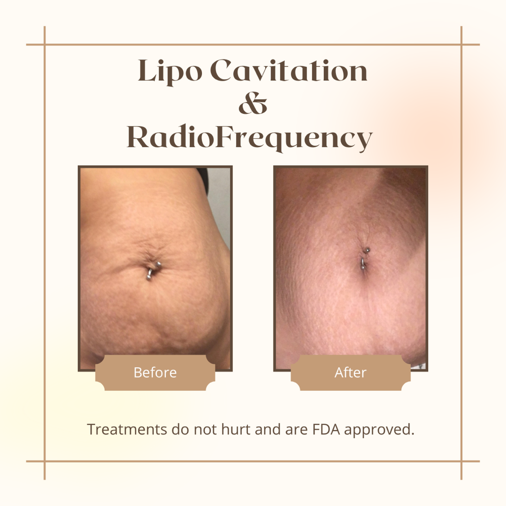 Lipo Cavitation Package Of 3