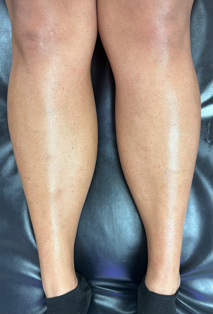 Lower Leg