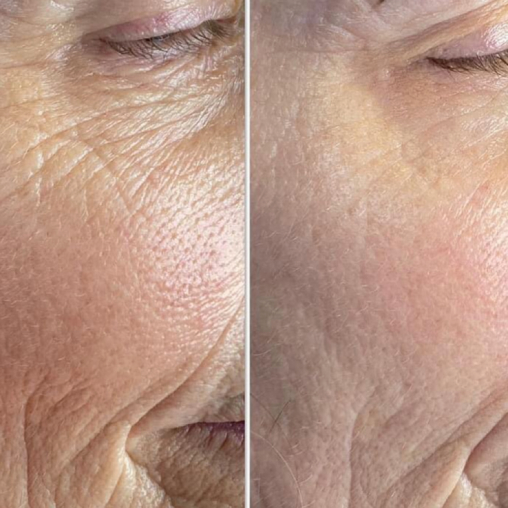 Microchanneling Package of 4 at Soul to Skin Esthetics in Bend, OR