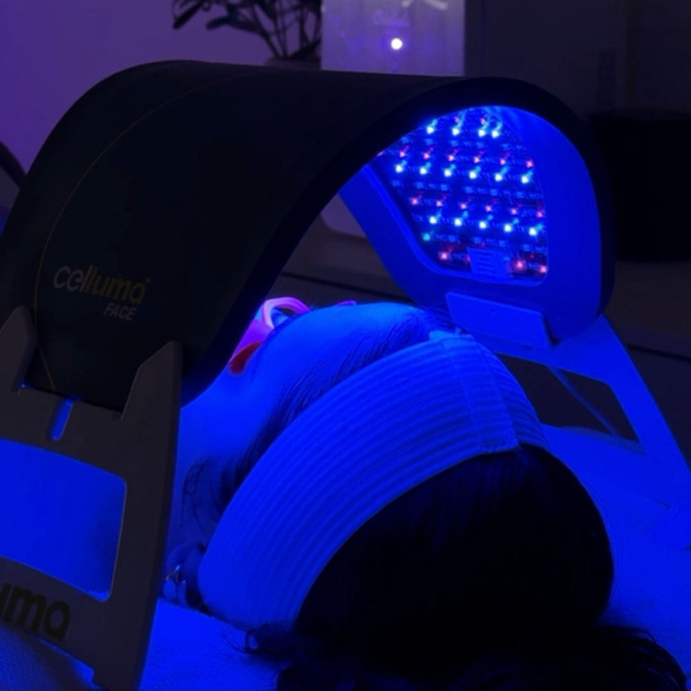 Acne Bootcamp Treatment at Cherry Glaze Esthetics in Camarillo, CA