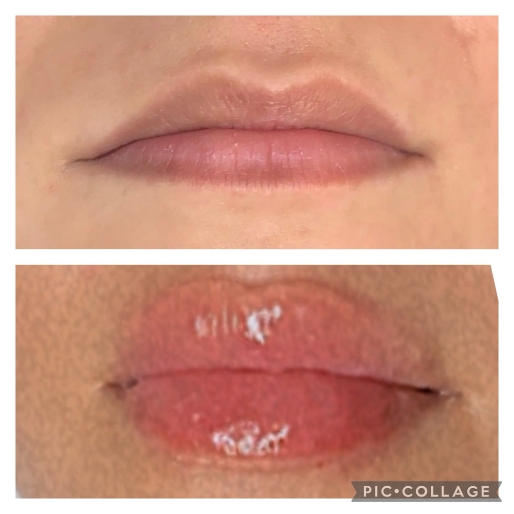Hyalauronic Lip Filler (Needleless)