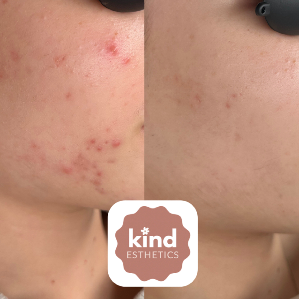 Kind And Clear Membership at Kind Esthetics in Spring, TX