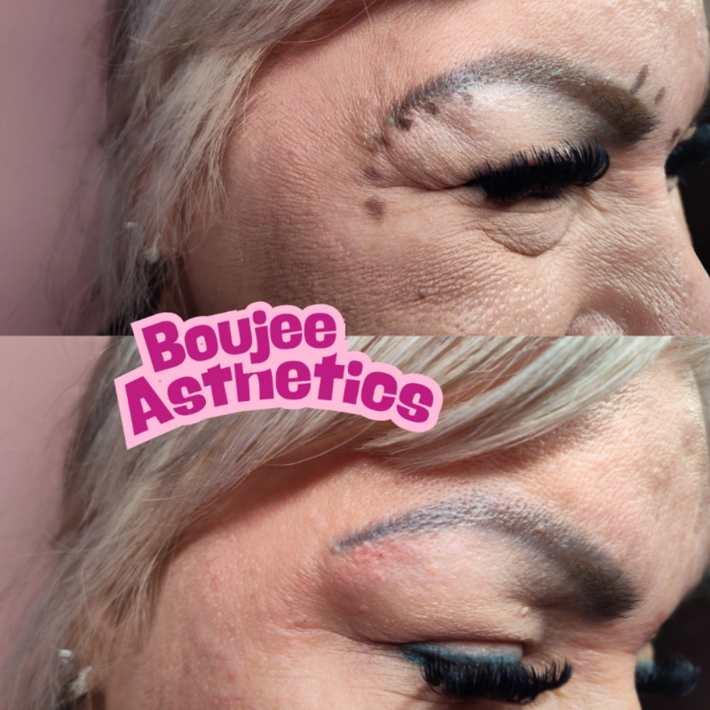 Botox ✨ at Boujee Asthetics ✨ in Tucson, AZ