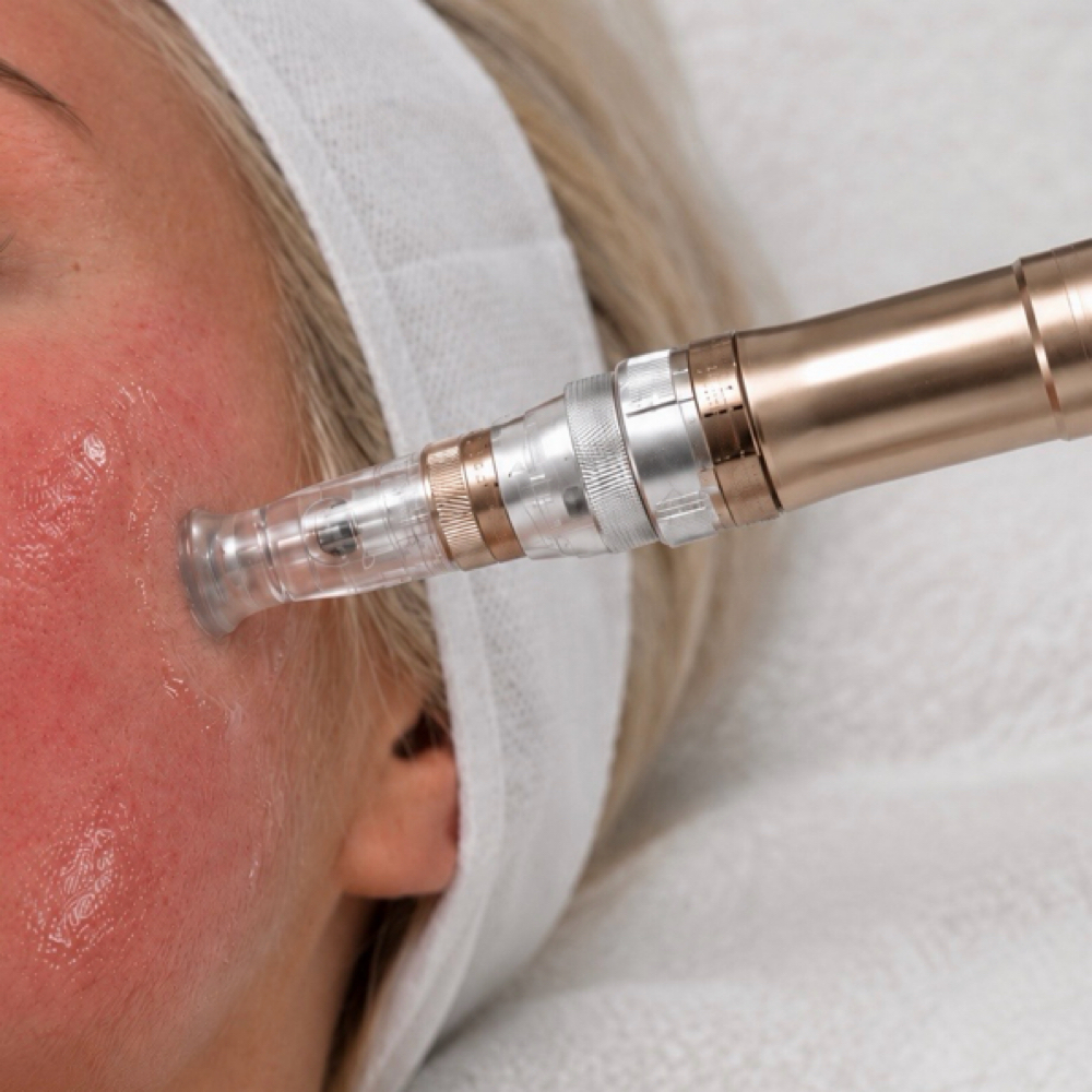 3 Microneedling Sessions at Nikki Rae Aesthetics in Scottsdale, AZ
