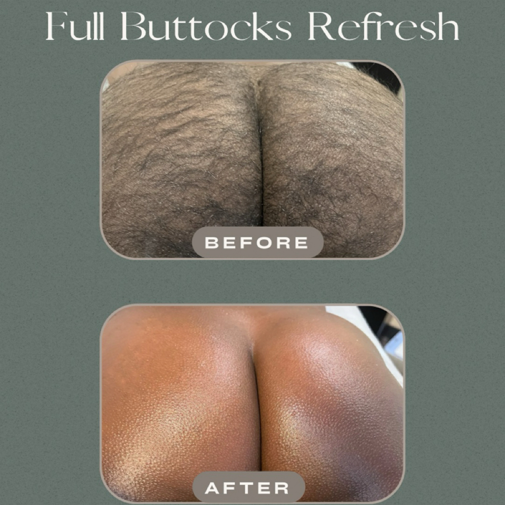 Full Buttocks Refresh | Houston at Bare RX + Wellness | Full Body Waxing in Midtown Houston in Houston, TX