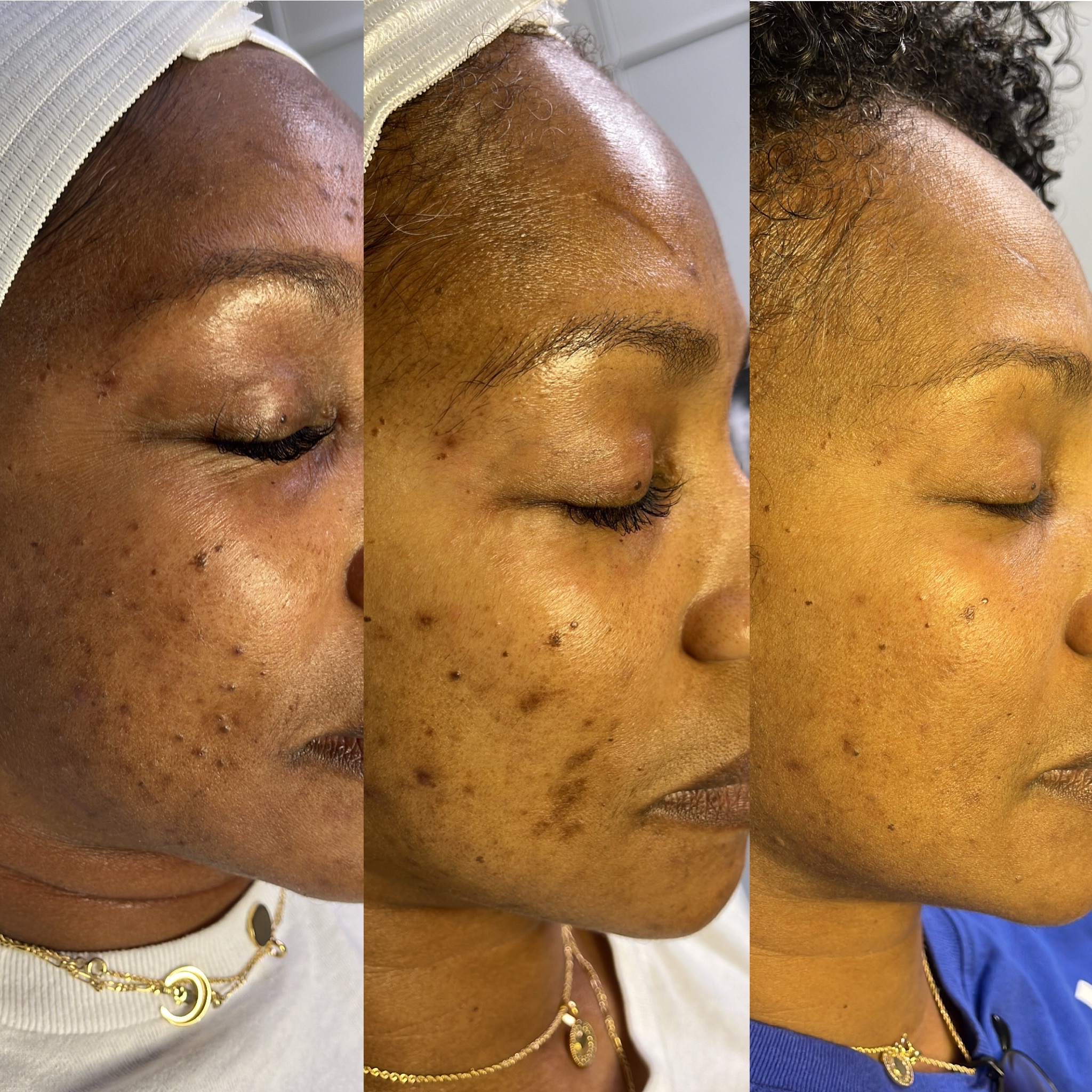 Microneedling/ Chemical Peel Combo