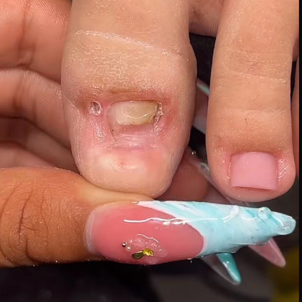 Reconstruction Toes at Custom_nails.juju in Houston, TX