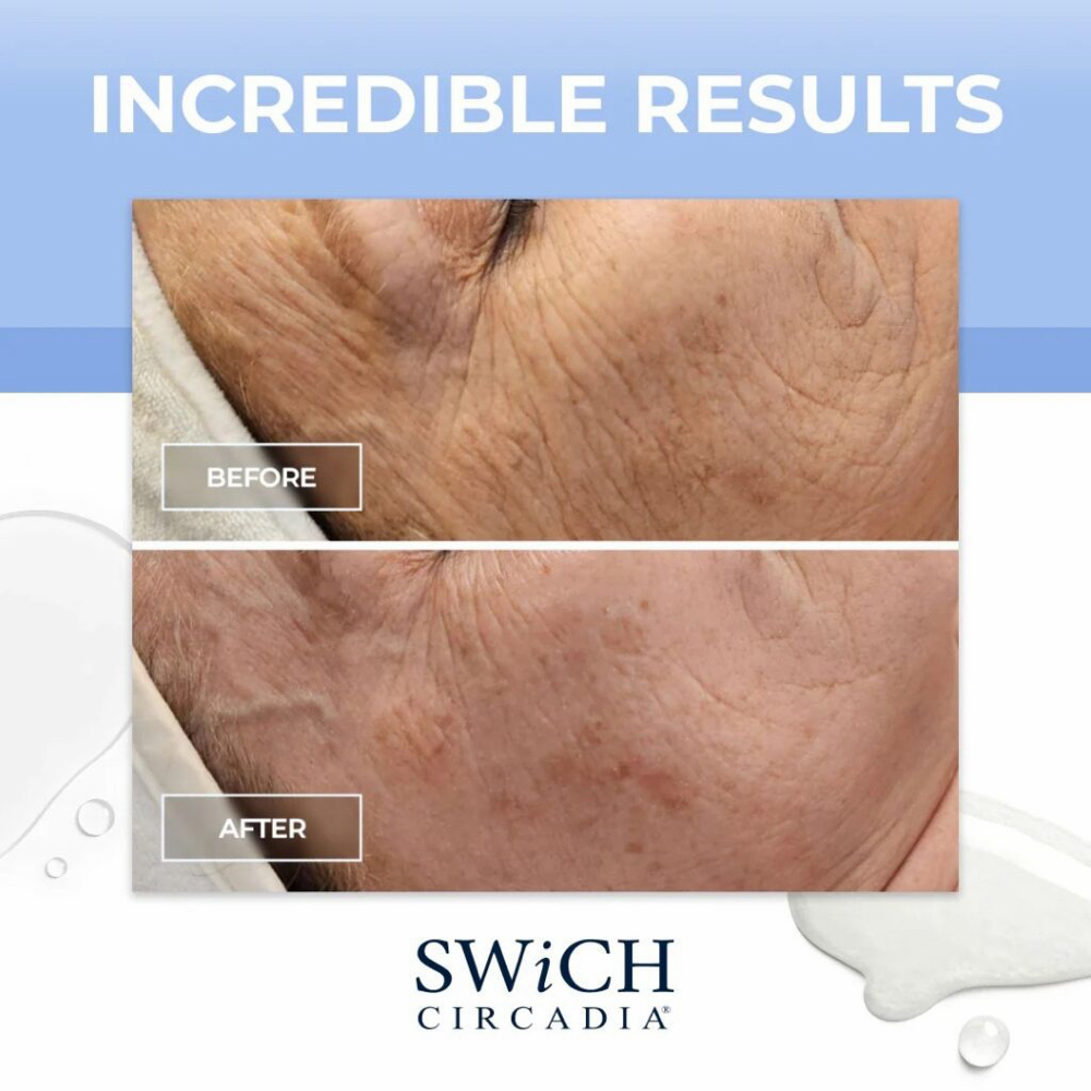 SWiCH Treatment + 2 Week Treatment at Sacred Moon Esthetics in Jackson, GA
