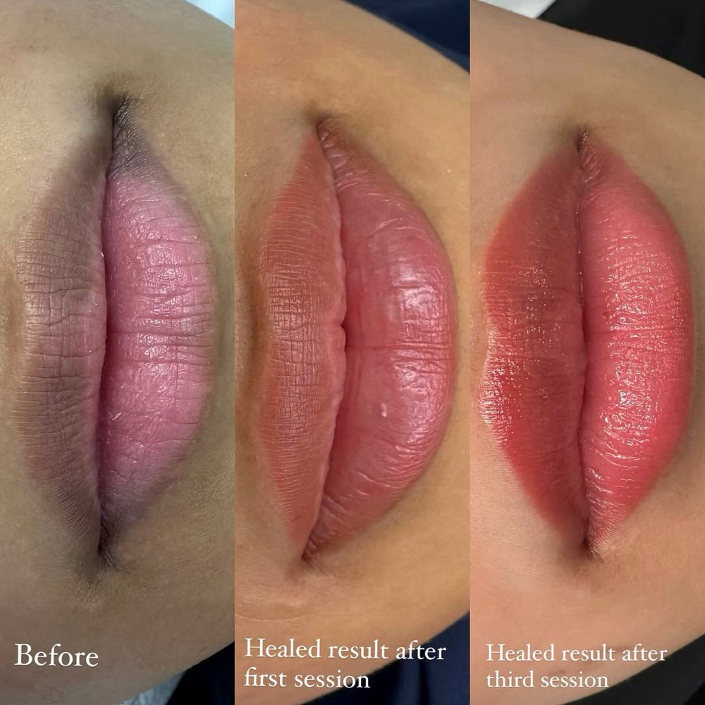 Full Lip Transformation Package at Phénix Beauty Lab in Dallas, TX