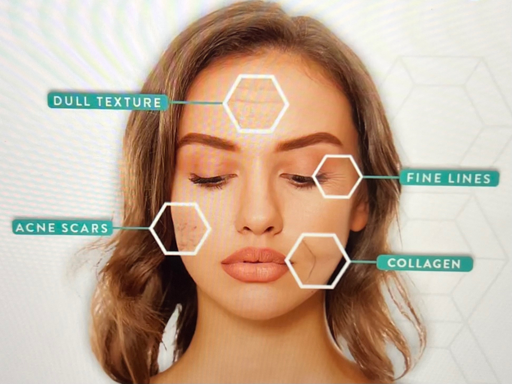 Morpheus8 Face