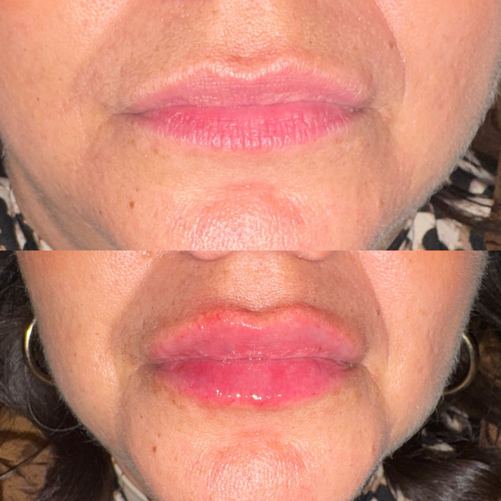 Lip Filler- RHA 2 at Timeless by Edie in Hebbronville, TX